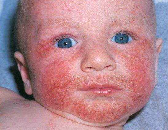 Красные пятна на теле у ребенка: фото с описанием