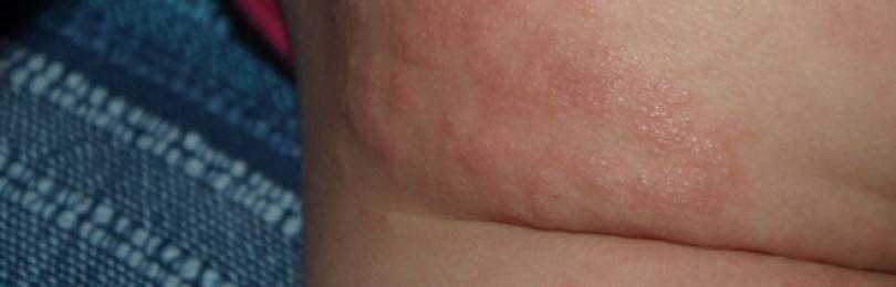Сыпь на попе у ребенка 6 лет. появились высыпания от аллергии на попе у ребенка. лечение аллергической сыпи на попе у ребенка