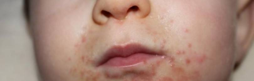 Аллергия на чеснок: может ли быть такое у взрослых и детей, как проявляются симптомы, а также фото недуга на коже и советы, чем стоит его лечить