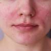 Аллергия на щеках