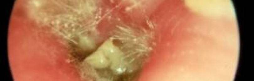 Грибок в ушах у человека: лечение грибкового заболевания и описание болезни