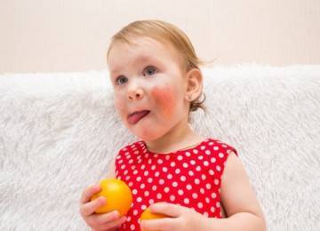 Аллергия на мандарины: фото проявлений реакции на цитрусовые