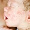 Как проявляется атопический дерматит у детей: симптомы и лечение