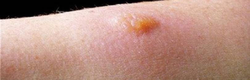 Аллергия на манту: причины, признаки, лечение и профилактика недуга