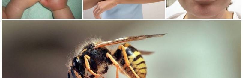 Что применять при укусе осы чем лечить укус осы при сильной аллергии