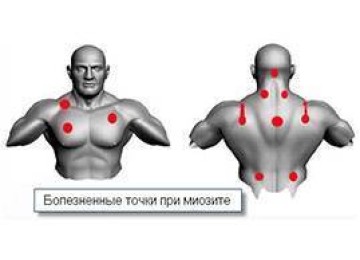 Миозит грудного отдела позвоночника по мкб 10