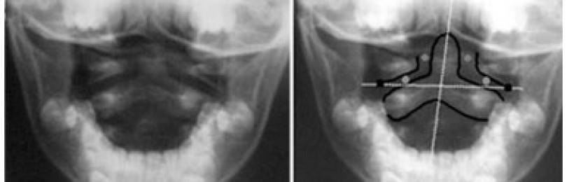 Подвывих шейного позвонка у ребенка или взрослого: лечение и симптомы, причины ротационного вывиха