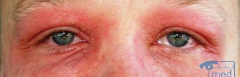 Причины аллергии на веках глаз