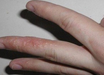 Водянистые пузырьки на пальцах рук: мелкие, лечение, как лечить