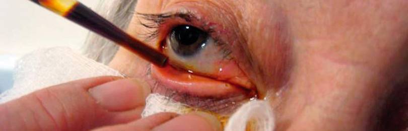 Как долго восстанавливается зрение после удаления катаракты