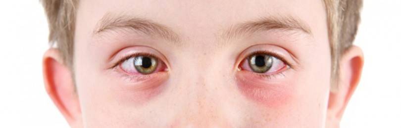 Почему у ребенка красные глаза и что делать?