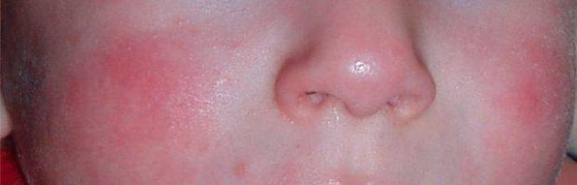 Аллергия на клубнику у ребёнка и взрослого: симптомы, фото, лечение и профилактика аллергической реакции