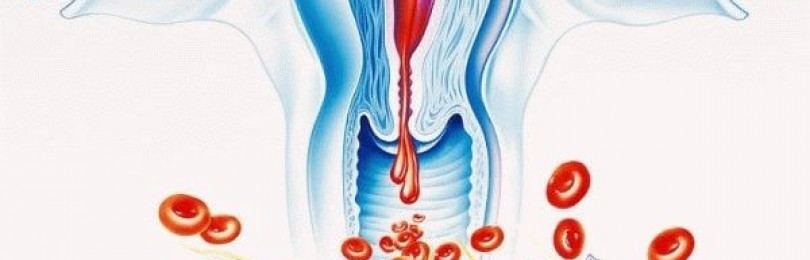Меноррагия (обильное менструальное кровотечение): причины и методы лечения