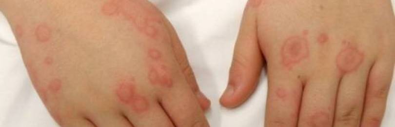 Аллергия на хлорку: причины и симптомы
