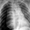 Лечение туберкулеза легких у взрослых: как проходит, чем и как долго?