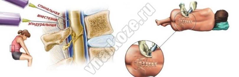Болит спина после эпидуральной анестезии причины лечение