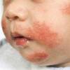 Аллергия на Лидокаин — признаки, первая помощь, лечение