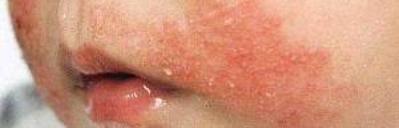 Аллергия на Лидокаин — признаки, первая помощь, лечение
