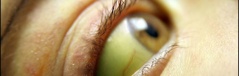 Как желтеют глаза при гепатите, циррозе, желтухе?