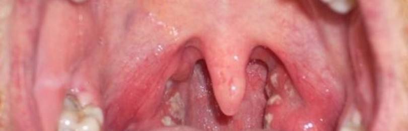 Симптомы отека горла и его лечение