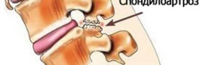 Спондилоартроз шейного отдела позвоночника