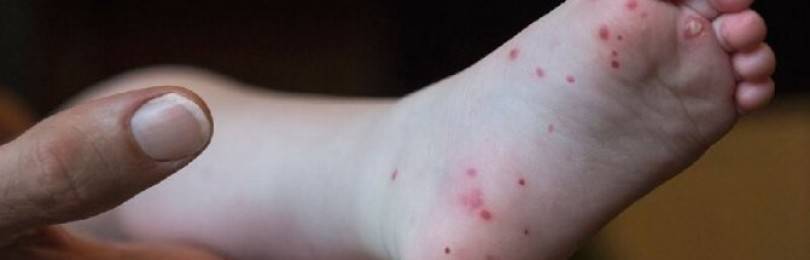 Скорая помощь на дому при аллергии на подгузники у детей