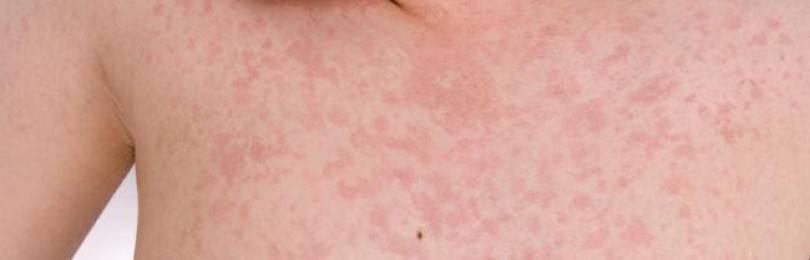 Аллергия на сою у грудничков, детей, взрослых, симптомы, лечение
