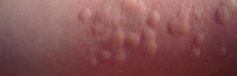 Нервный дерматит: фото, симптомы и лечение кожных заболеваний на нервной почве