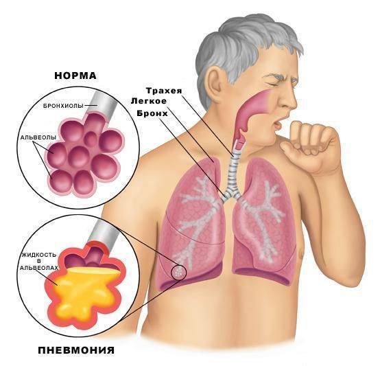 Правила выполнения дыхательной гимнастики при пневмонии