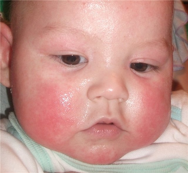 У ребенка шелушится кожа на лице: опасно ли явление и как с ним бороться?