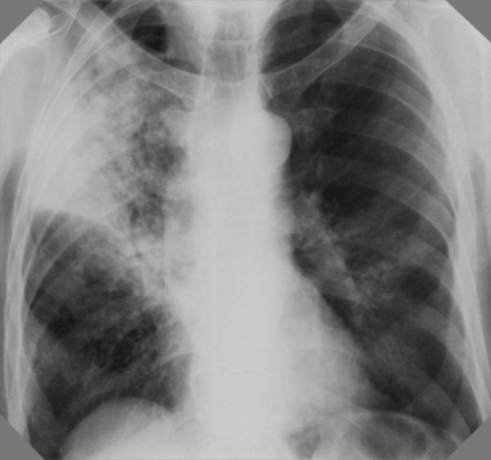 Как обнаружить туберкулез на рентгене? может ли снимок не показать болезнь?