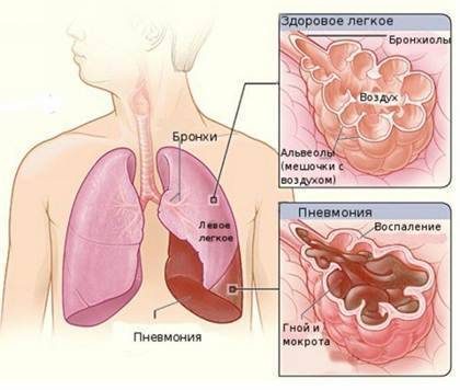 Пневмония у новорожденных - врожденная, внутриутробная форма: причины и последствия пневмонии после кесарева сечения, симптомы