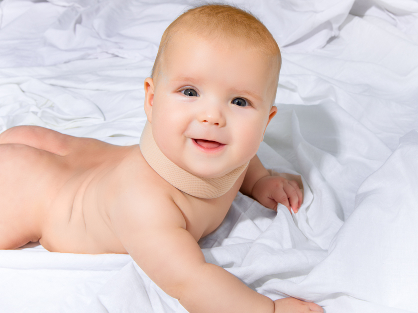 Кривошея у младенцев признаки фото