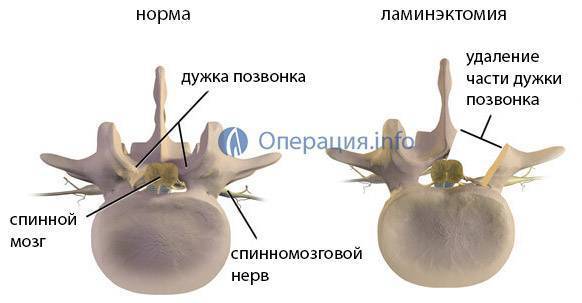 Остистые отростки позвоночника фото