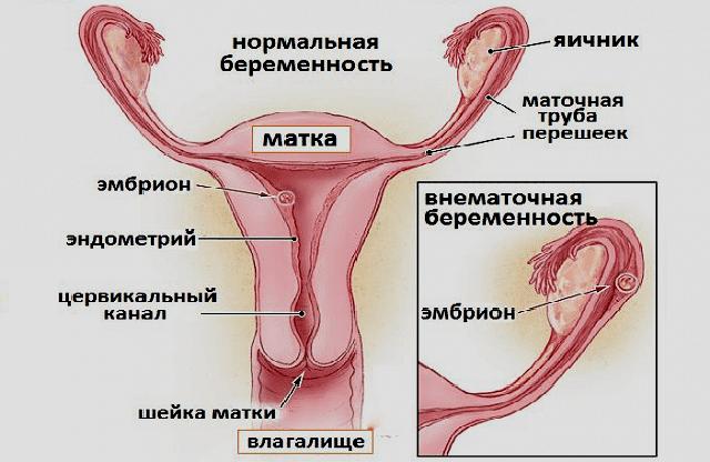 Внематочная беременность - симптомы и первые признаки внематочной беременности у женщин |
            эко-блог