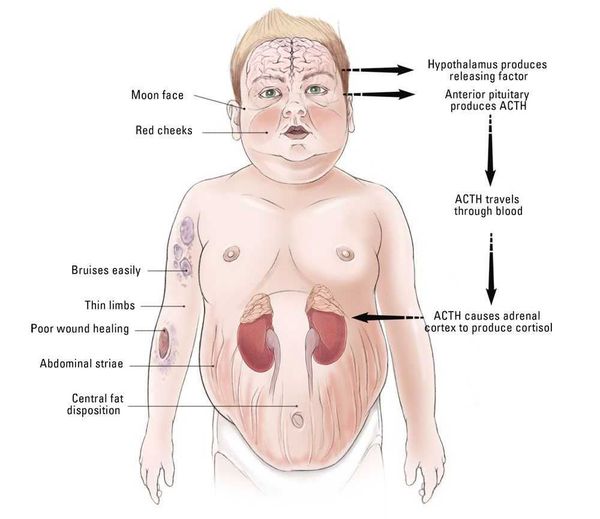 Синдром кушинга: причины развития болезни, симптомы и лечение