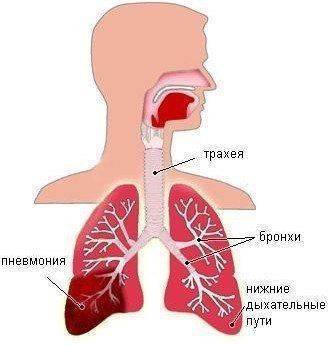 Крупозная пневмония – симптомы, лечение