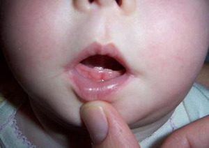Первые признаки прорезывания зубов у грудничка до года: как понять, что лезут