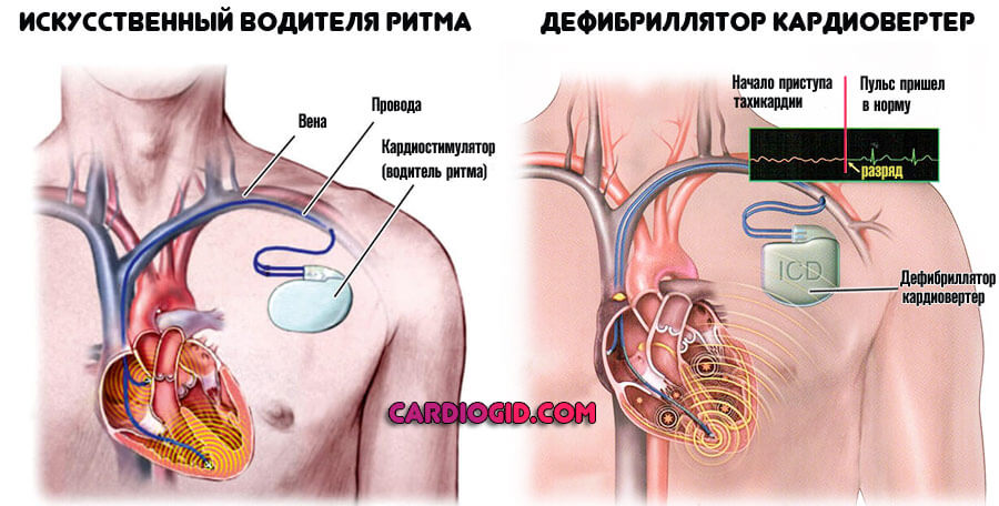 Кардиостимулятор сердца картинки