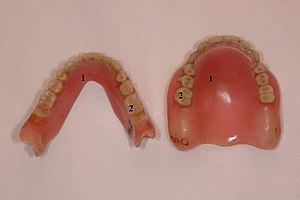 Мостовидный протез на имплантах и его фото — установка зубного моста