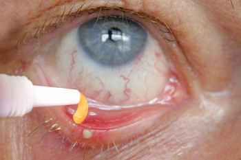Тетрациклиновая глазная мазь: инструкция по применению для детей и взрослых, как наносить тетрациклиновую мазь для глаз