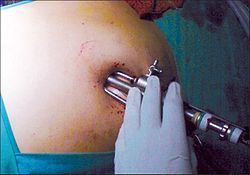 Операция лапароскопия: как проводится, область применения и этапы
