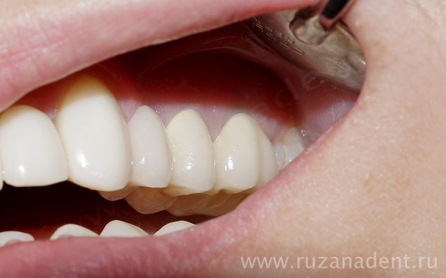 Протезирование зубов на имплантах