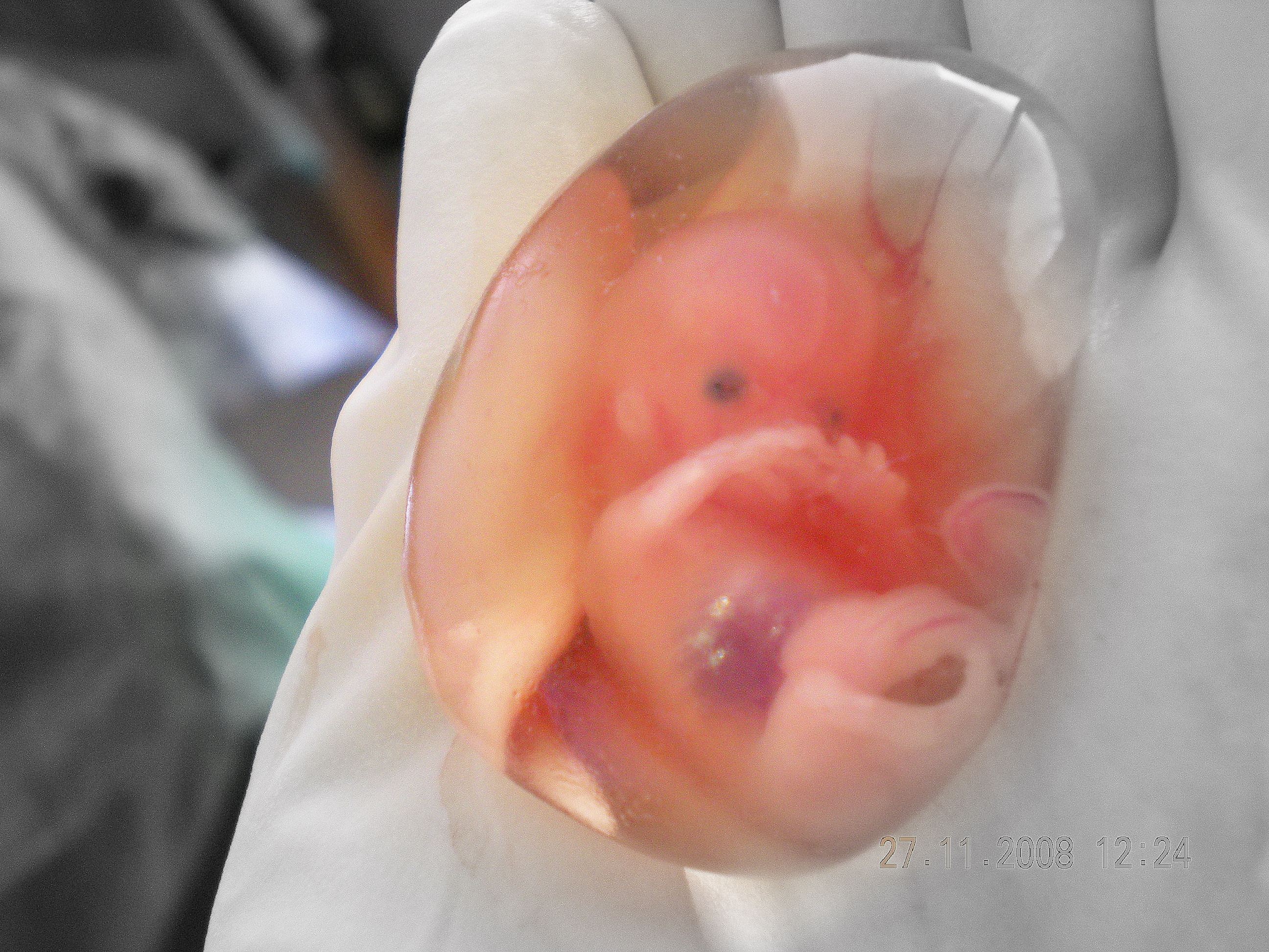 Хирургический аборт: о чем нужно знать, решаясь на этот шаг