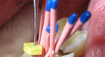 Восстановление разрушенного зуба (штифты и коронки)