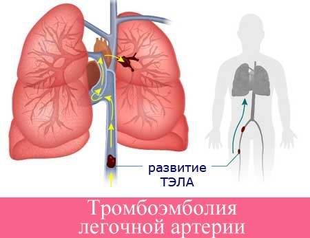 Рецидивирующая тромбоэмболия легочной артерии. способы диагностики и лечение