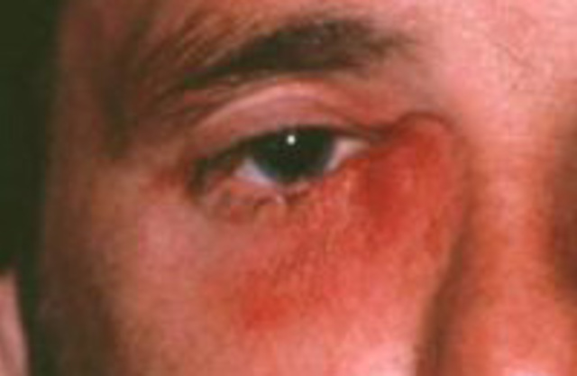 Воспаление глаза - виды, симптомы, лечение