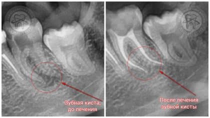 Что такое киста зуба и как её лечить