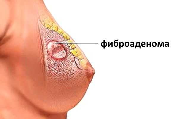 Листовидная фиброаденома молочной железы