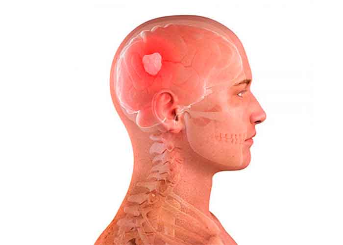 Онемение лица и головы признак какой болезни